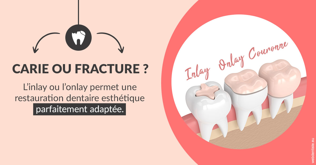 https://dr-voican-ioana.chirurgiens-dentistes.fr/T2 2023 - Carie ou fracture 2