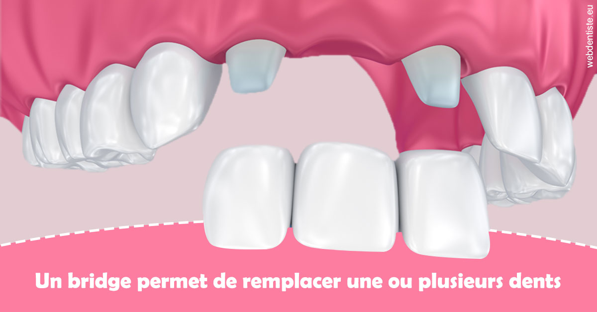 https://dr-voican-ioana.chirurgiens-dentistes.fr/Bridge remplacer dents 2
