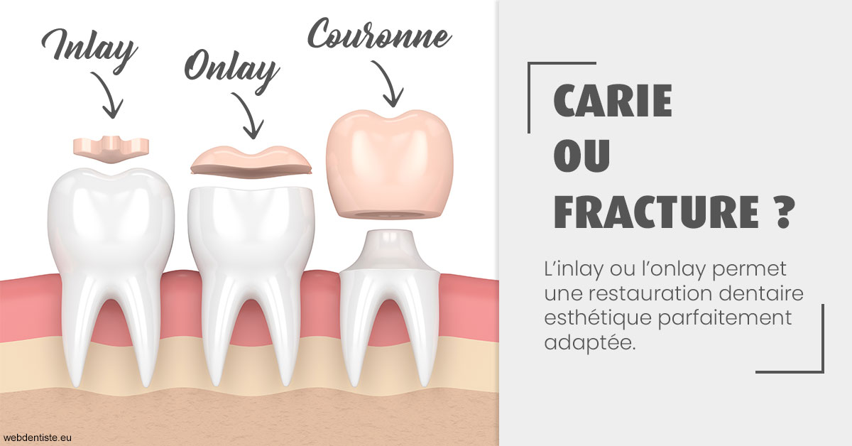 https://dr-voican-ioana.chirurgiens-dentistes.fr/T2 2023 - Carie ou fracture 1