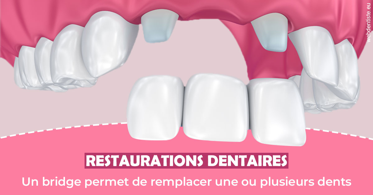 https://dr-voican-ioana.chirurgiens-dentistes.fr/Bridge remplacer dents 2