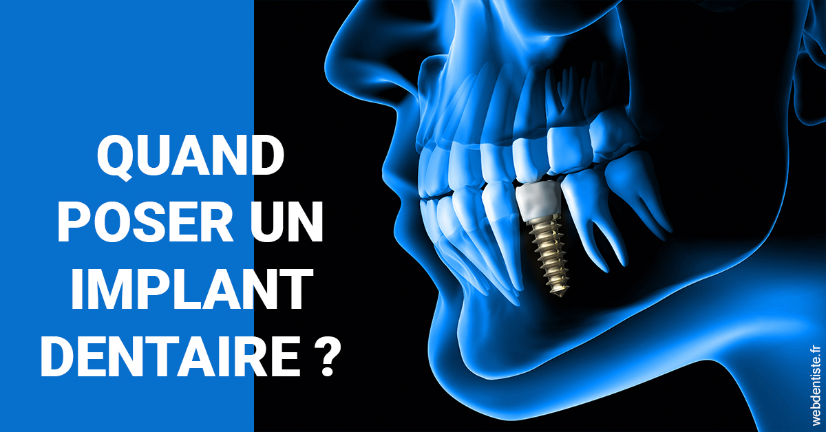 https://dr-voican-ioana.chirurgiens-dentistes.fr/Les implants 1