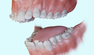 Traitement orthodontique : Appareil multi-attache en céramique